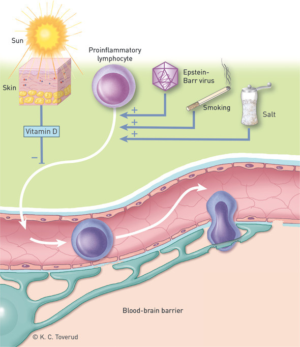 Figure 1  A simplified overview of Epstein-Barr virus, smoking and vitamin D as environmental factors in the development of…