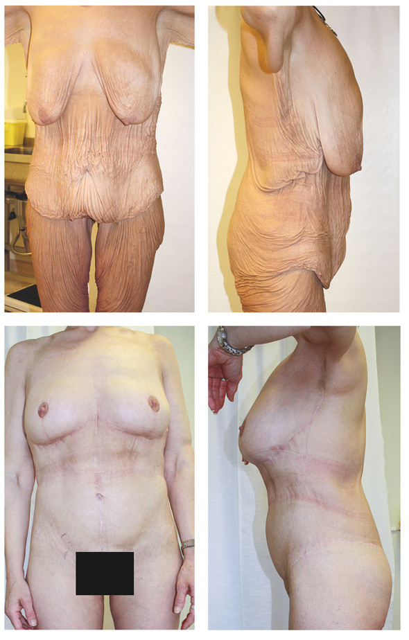 Figure 1 Woman in her thirties who lost 100 kg through dieting and exercise. The top two images show the patient before…