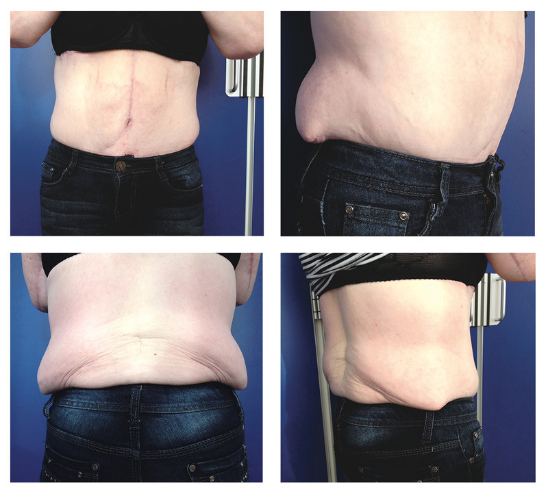 Figure 2 Poor outcome after abdominoplasty in a patient who should rather have had a lower body lift. This illustrates the…