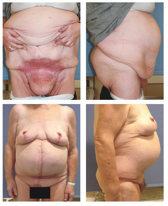 Figure 3 Woman in her fifties who had previously been refused treatment due to a high body mass index. The top two images…