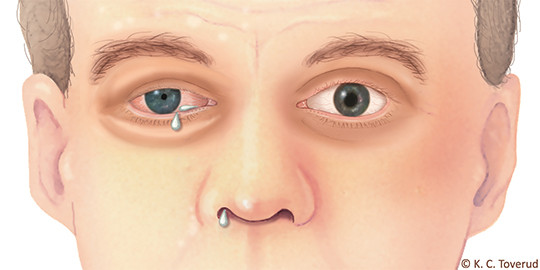 Figure 1  Cranial autonomic signs during a cluster headache attack. Partial Horner’s syndrome (ptosis, miosis), conjunctival…