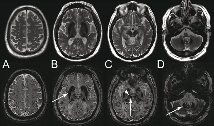 Figure 1  Cerebral MRI of the patient in his late 50s. T2-weighted (upper row) and susceptibility-weighted (SWI, bottom row)…