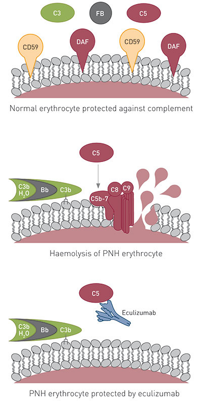 Figure 2  A schematic presentation of how eculizumab protects the erythrocyte against lysis in paroxysmal nocturnal…