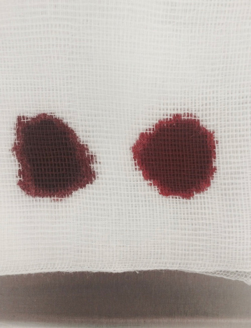 Figure 2  Brown blood. Patient’s arterial blood on the left. Treating doctor’s arterial blood on the right