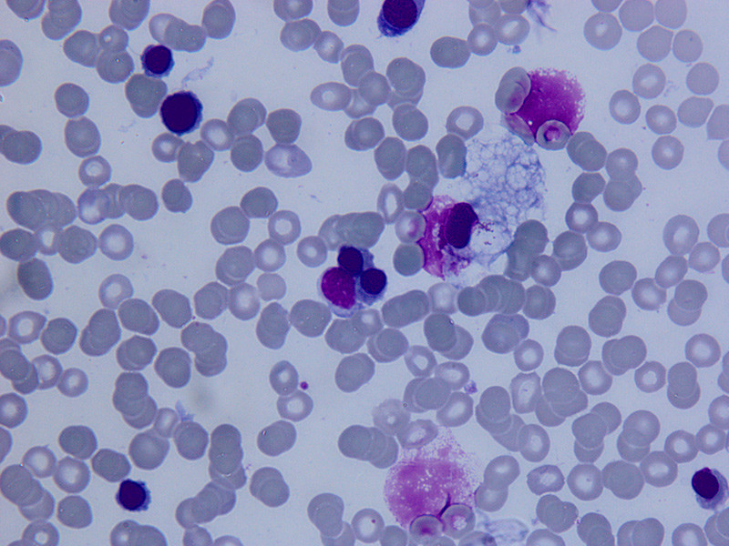 Figure 1  Light micrograph of bone marrow smear stained with May-Grünwald-Giemsa. Anisopoikilocytosis and abnormal…