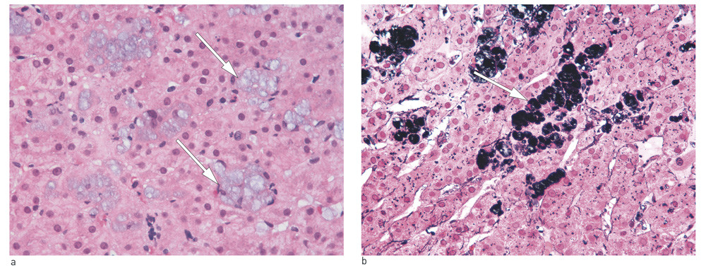 Figure 3  Light micrograph of hepatic tissue, showing accumulation of polyvinylpyrrolidone (PVP) or povidone-containing…