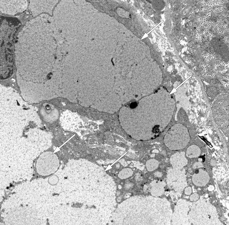 Figure 4  Transmission electron micrograph of hepatic tissue. Intracellular accumulation of polyvinylpyrrolidone (PVP) or…