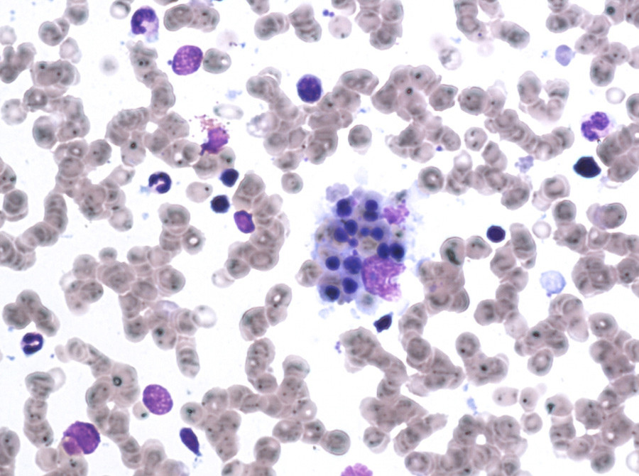 Figure 1  Image of the patient’s bone marrow aspirate showing occasional stromal macrophages containing phagocytosed…