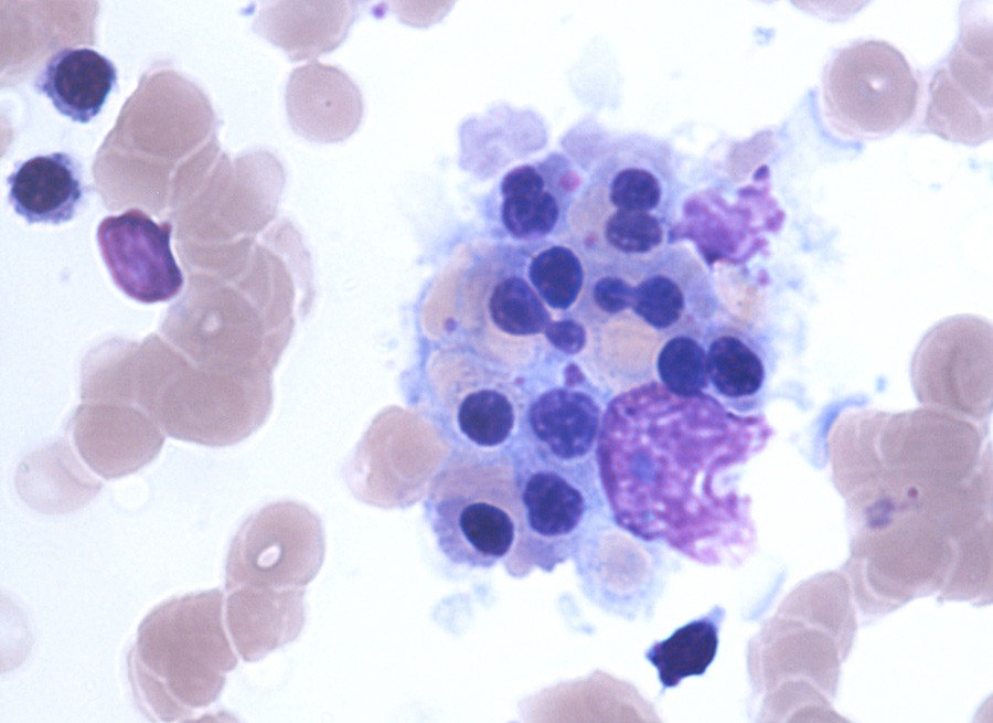 Figure 2  Magnified section of Figure 1 showing the patient’s bone marrow aspirate