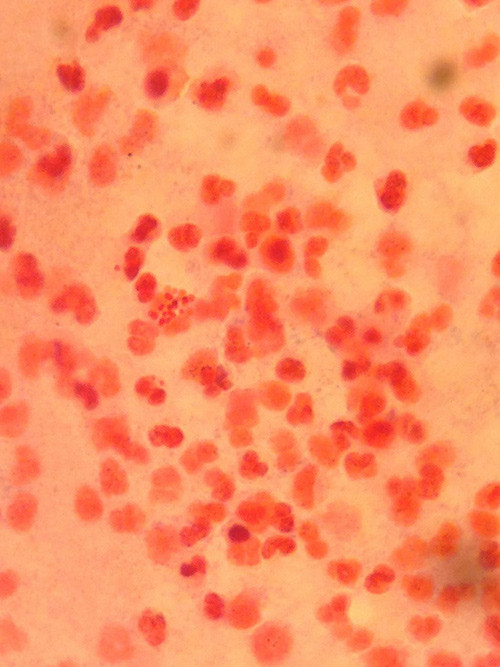 Figure 2  Microscopy results. Gram stain showing gram-negative diplococci from puncture of the right ankle