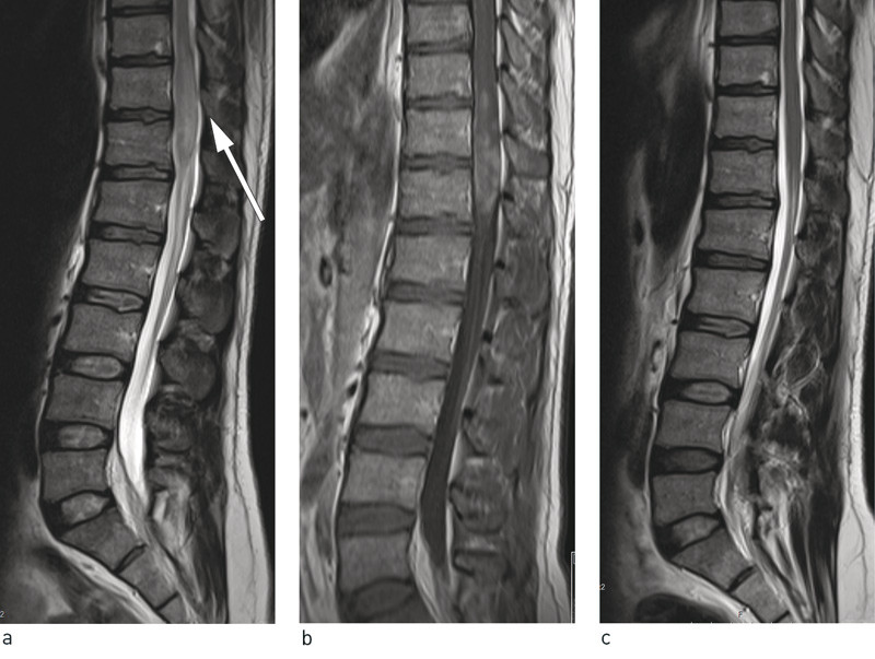 Figure 1  Lumbosacral spine MRI showing expansion of the medullary cone at level Th 11/Th 12 with hyperintensity on T2…
