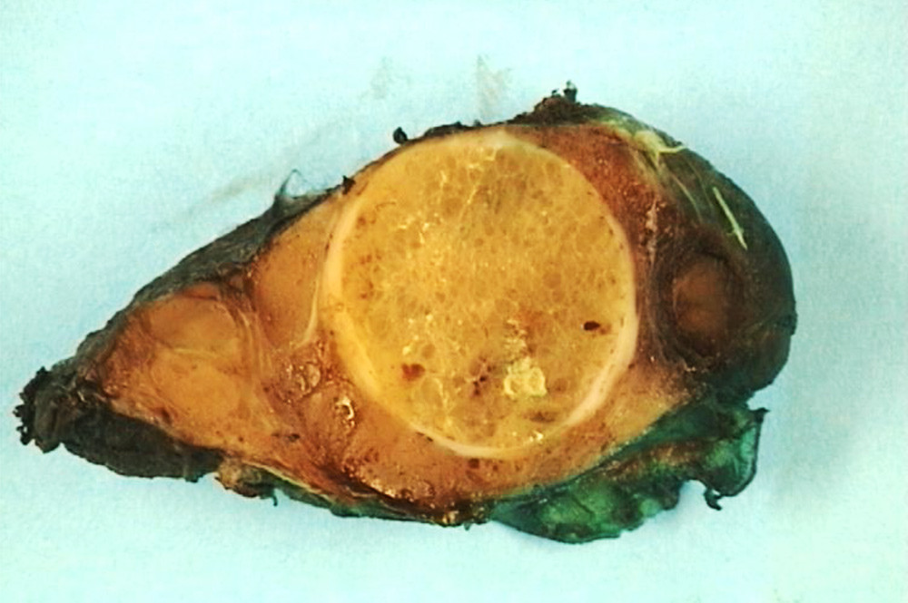 Figure 1  Image (macroscopic) of left thyroid lobe with one large and several small nodules. Both photos: Krystyna Kotanska…