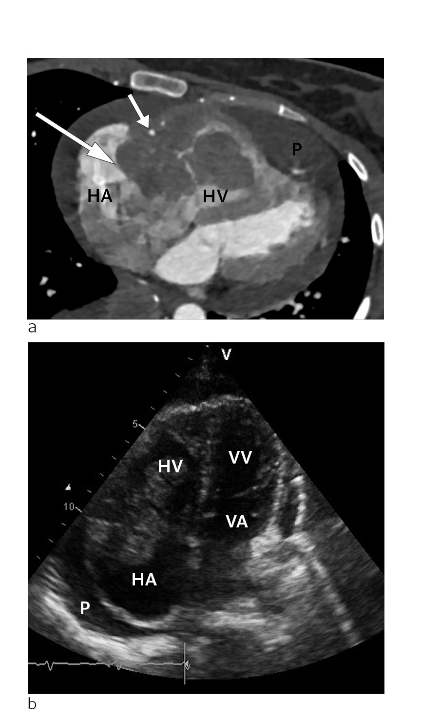 Figure 1 a) CT scan of the heart in the transverse plane at the time of diagnosis. Tumour (large arrow) in the right…