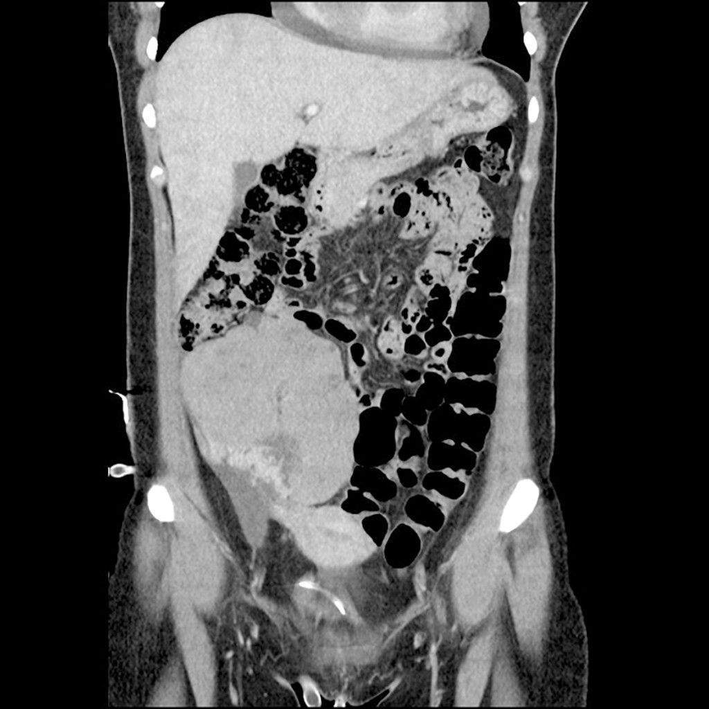 Figure 2 CT abdomen in the frontal plane at the time of diagnosis. A CT scan of the patient after hospitalisation revealed a…
