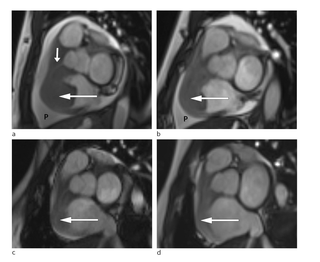 Figure 3 Short axis view of cardiac MRI at different disease stages. a) Large tumour at the time of diagnosis (large arrow)…