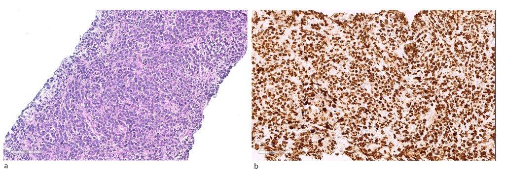 Figure 4 Histopathological diagnosis. a) Haematoxylin-eosin stained sections with diffuse infiltration of moderately large…