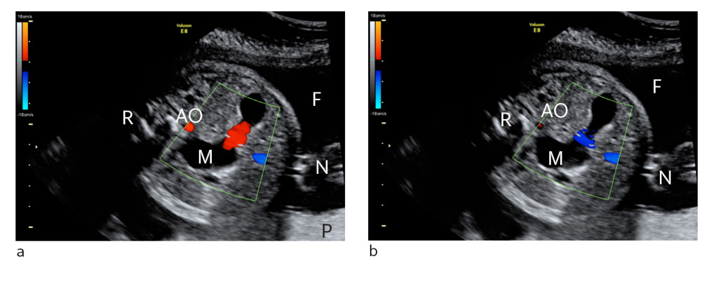 Figure 1 Ultrasound showing cross-section of fetal abdomen at gestational week 29 a) Stomach contents moving towards the…