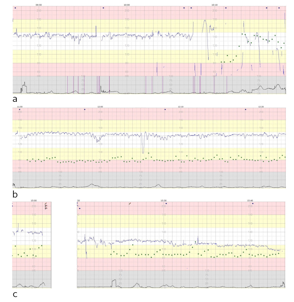 Figure 2 Cardiotocography (CTG) showing fetal heart rate (blue line), contractions (black line), maternal pulse (green dots)…