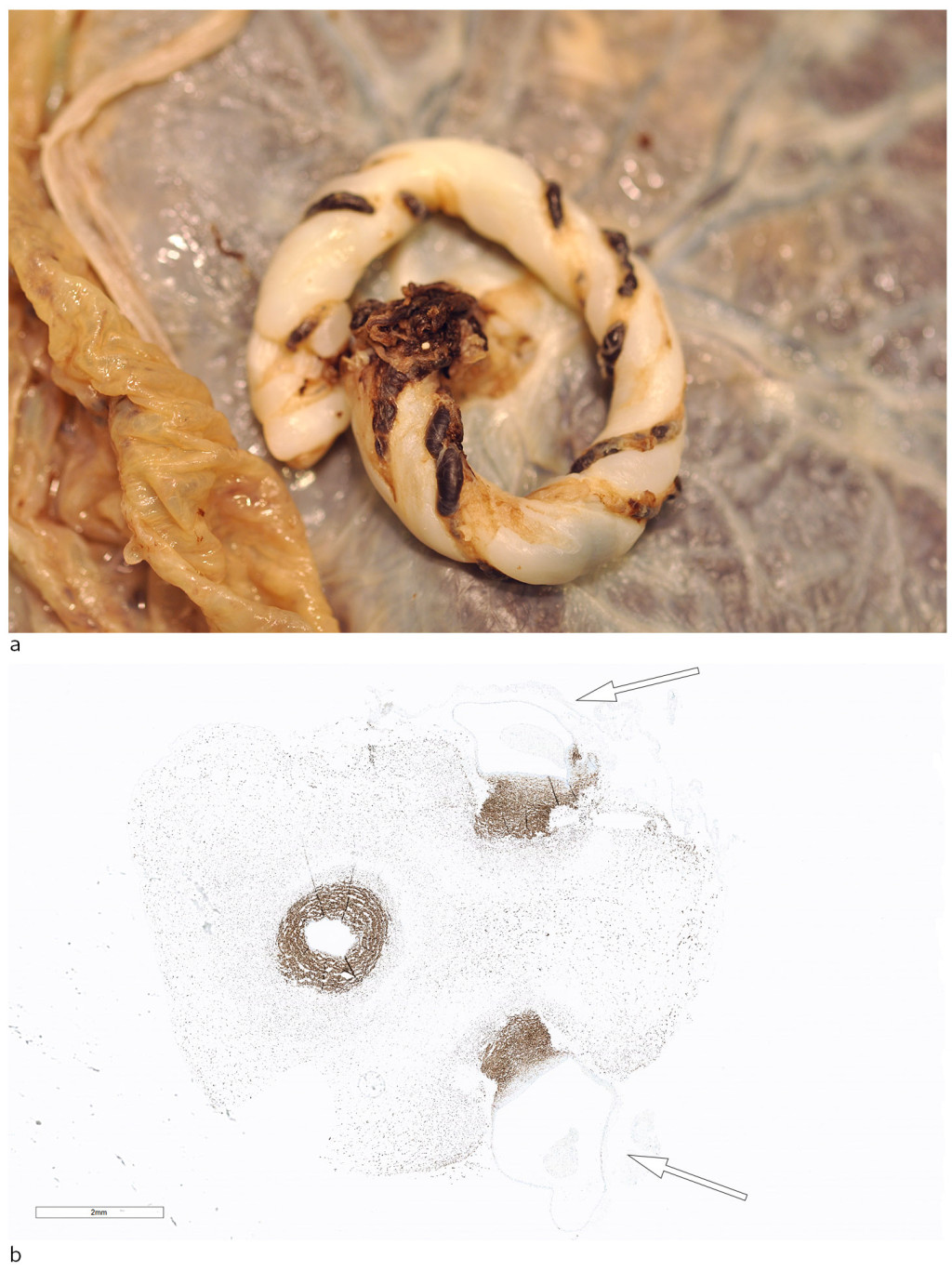Figure 4 a) Cord after formalin fixation. B) Cord cross-section stained with the muscle marker desmin. Destruction of the…