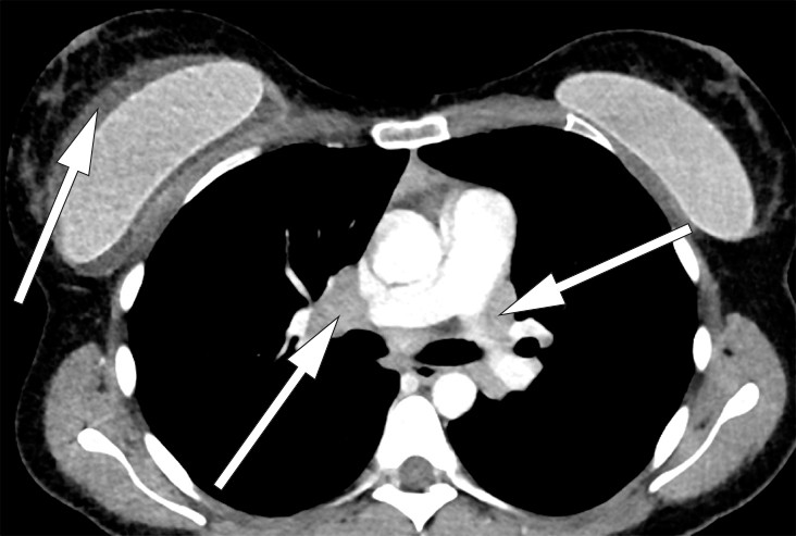 Figure 1 CT thorax with intravenous contrast, sagittal section. A lymph node conglomerate measuring 3 cm is seen in the&hellip;