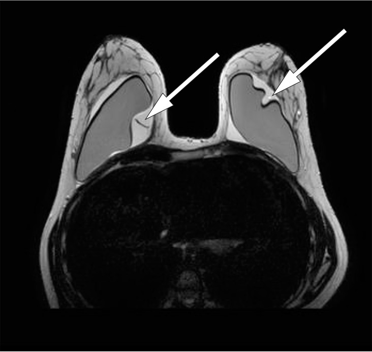 Figure 2 Breast MRI, T2-weighted sequence. Suspected bilateral implant rupture. A substantial amount of fluid surrounding&hellip;