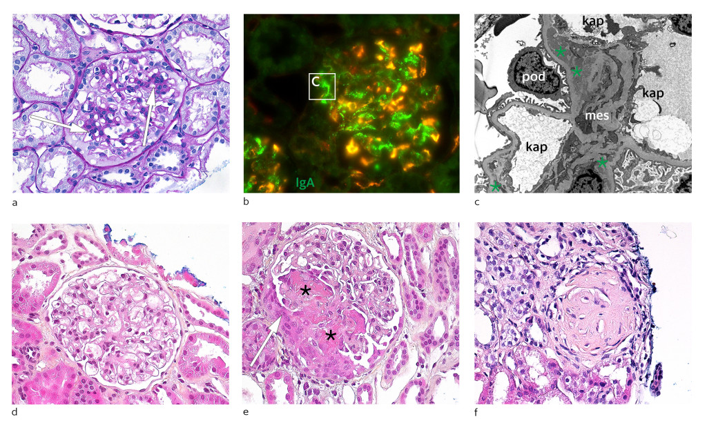 Figure 1 a-c ) IgA vasculitis. d-f) ANCA-associated vasculitis. a) Mesangioproliferative glomerulonephritis with increased…