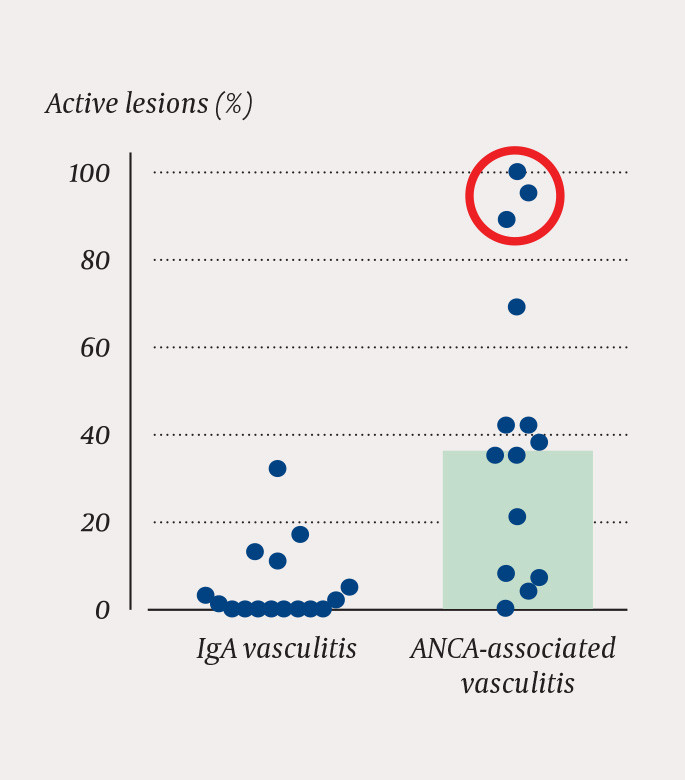 Figure 2 Percentage of glomeruli with active lesions (crescents/necroses). Each point represents a biopsy from a patient,…