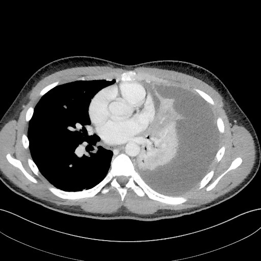 Figure 1 Axial CT images of the chest obtained one week after hospitalisation revealed that almost the entire left thoracic…
