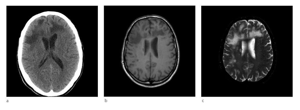 Figure 1 a) In patient 1, CT of the head showed bilateral non-specific confluent hypointensities in frontal subcortical…