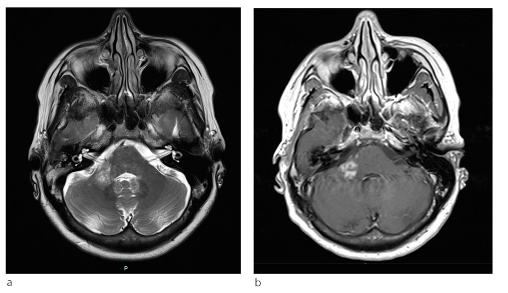 Figure 2 a) The T2-weighted image shows an inhomogeneous hyperintense lesion in the right cerebellar peduncle that cannot…