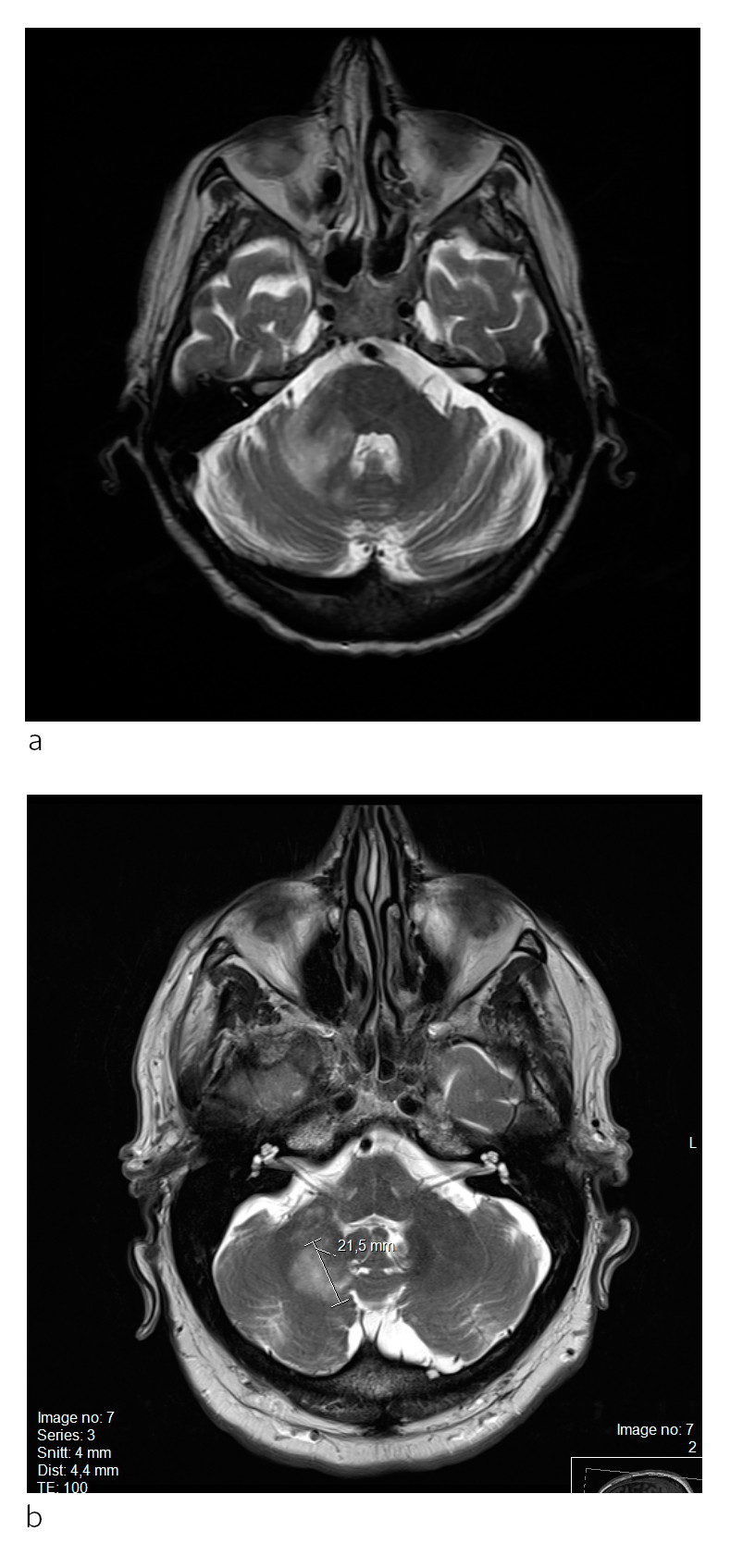 Figure 3 a) T2-weighted MRI showing crescent-shaped hyperintensity in the right cerebellar hemisphere and in the upper…