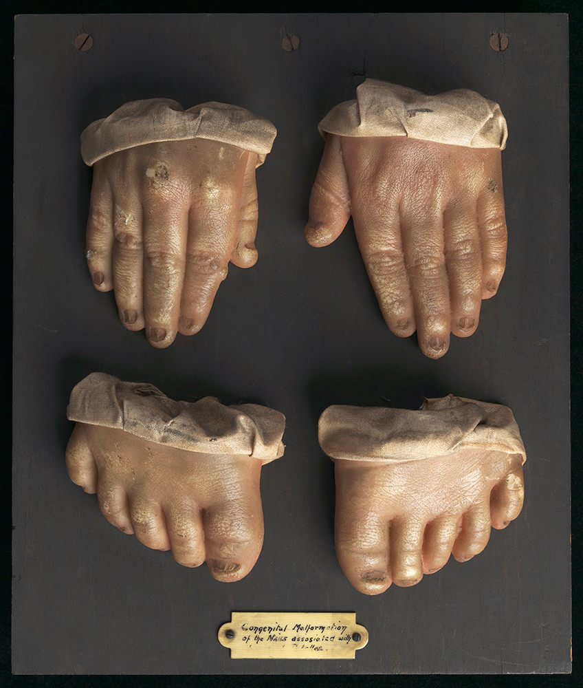 Wax casts (moulage) have been used to create medical archives for educational purposes since the Renaissance, and there are&hellip;