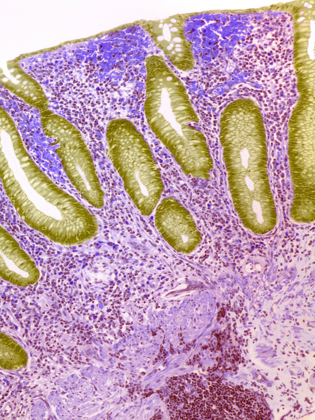 Tarm hos en person med Crohns sykdom, med sårdanning (grønt) og granulomer (nederst til høyre). Illustrasjonsfoto: Science…
