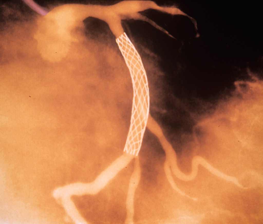 Farget angiogram av et snitt gjennom et hjerte som viser en stent implantert i en kranspuls&aring;re for &aring; behandle stenose &hellip;