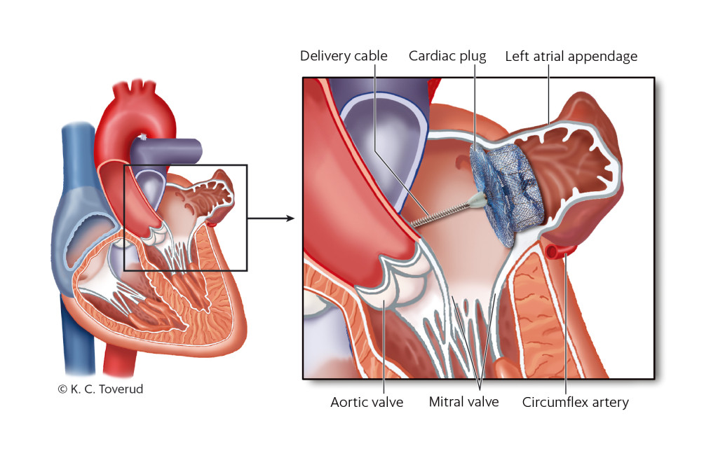 Figure 1 On the left, a four-chamber view of the heart. The cut-out on the right shows the left atrium with the cardiac plug…