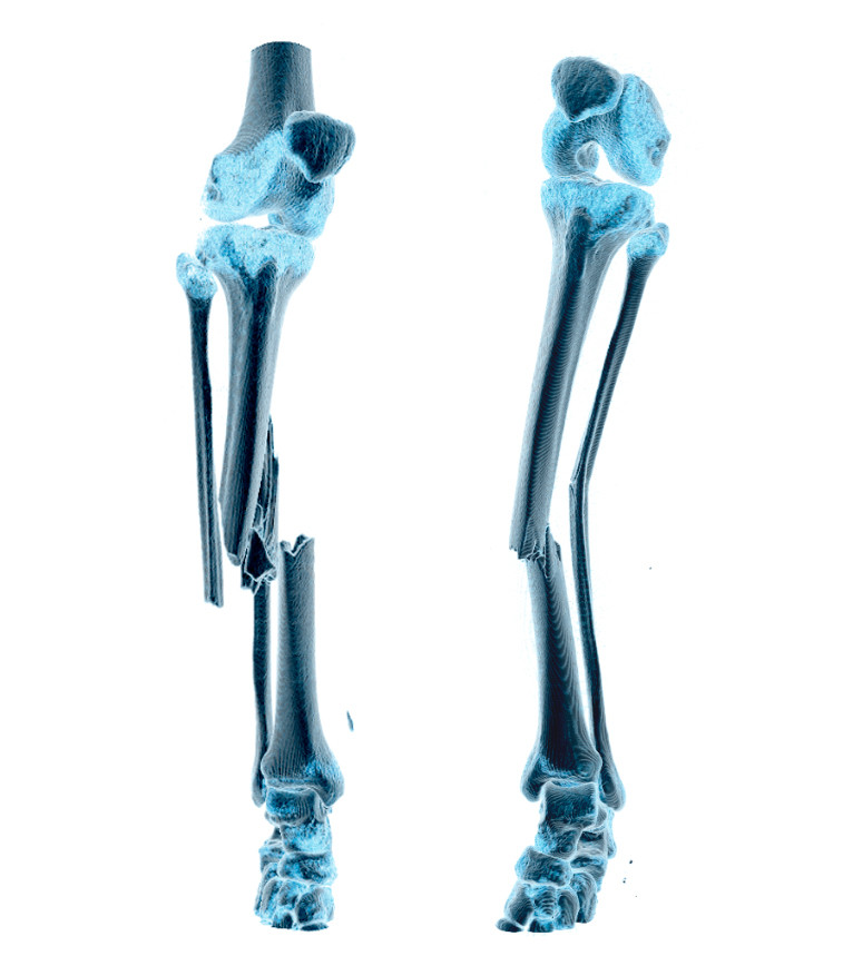 Figure 1 CT images with three-dimensional presentation of left (shown to the right) and right tibia (shown to the left)…