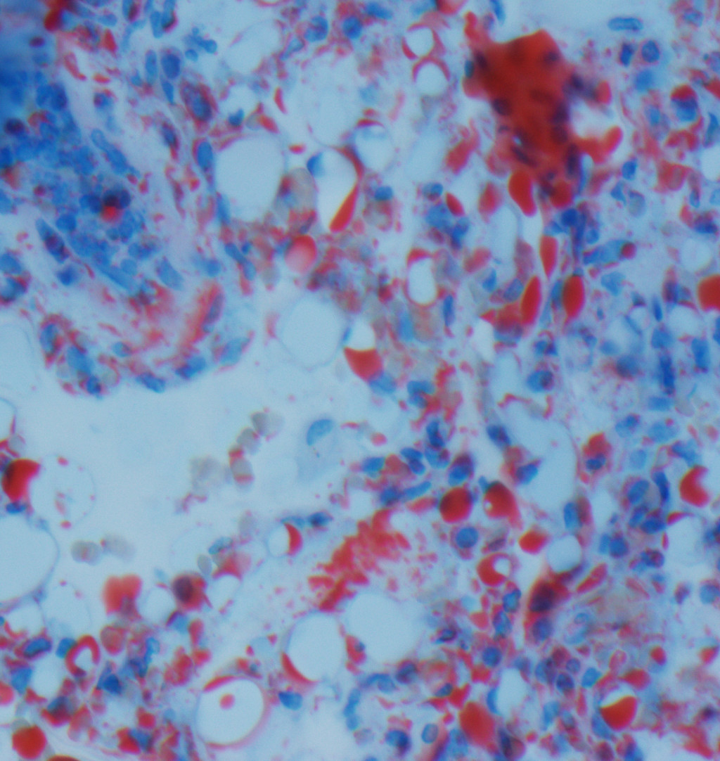 Figure 2 Histopathological section of lung tissue stained with oil red O. Fat is seen as half-moons and globules, which…