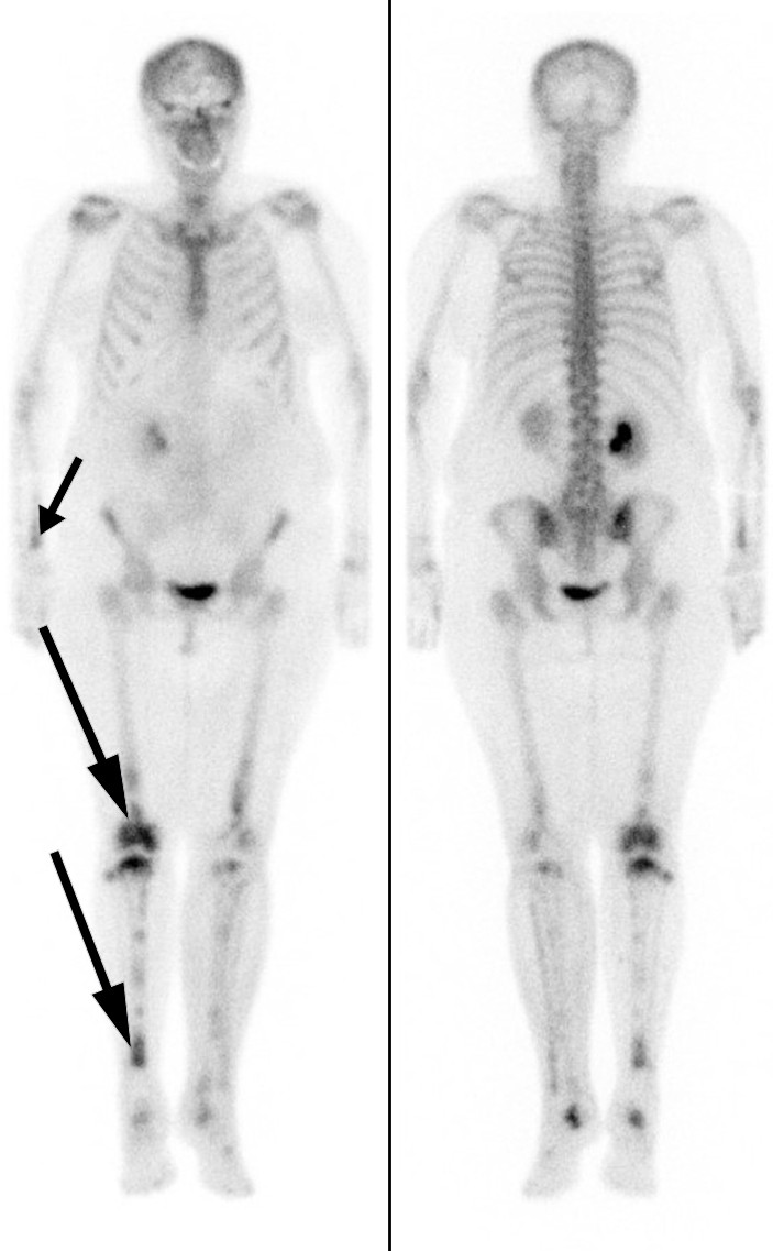 Figure 3 Skeletal scintigraphy with technetium-99 m showing increased radionuclide uptake in both lower extremities,&hellip;