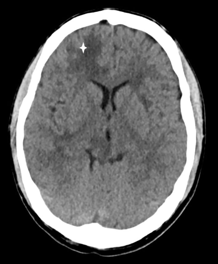 Figure 1 CT head without contrast medium showing low-attenuation changes in frontal white matter in the right cerebral…