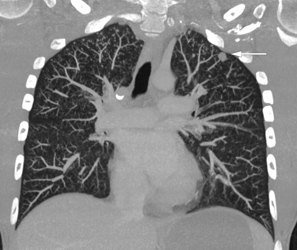 Figure 3 CT thorax taken after injection of intravenous contrast medium. The image shows multiple micronodules in the tops…