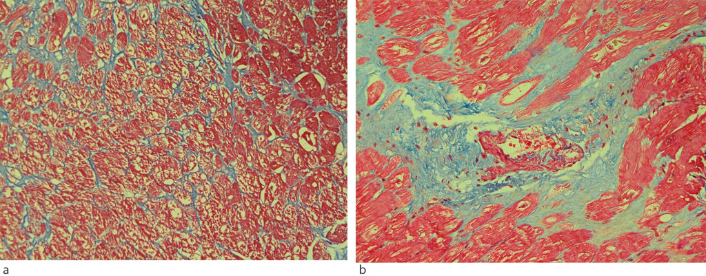 Figure 4 Myocardial biopsies from patients with hypertrophic cardiomyopathy. Masson trichrome stains connective tissue blue…