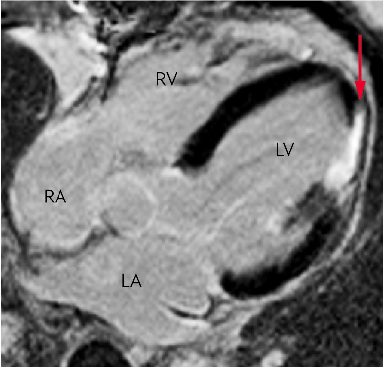 Figure 5 Cardiac MRI scan after injection of gadolinium-based contrast. The left ventricle shows increased signal (red arrow…