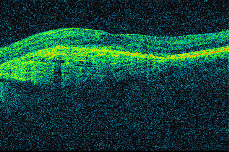 Figure 3 OCT of the macula in the same patient three years later, following repeated anti-VEGF injections. Conditions are&hellip;