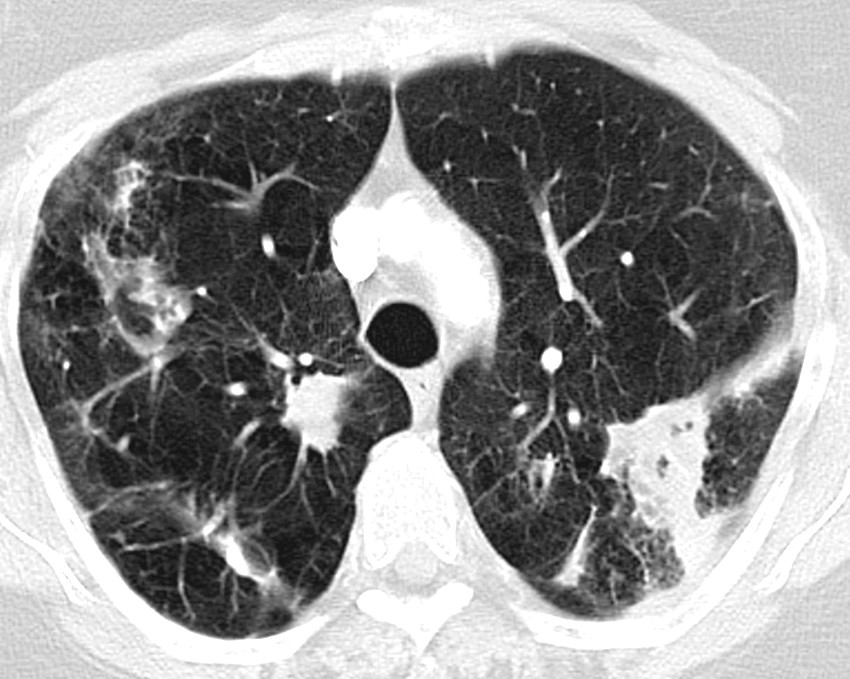 Figure 1 CT thorax of a patient with severe COPD with emphysema. Cavernous and fibrotic changes and infiltrates are seen…