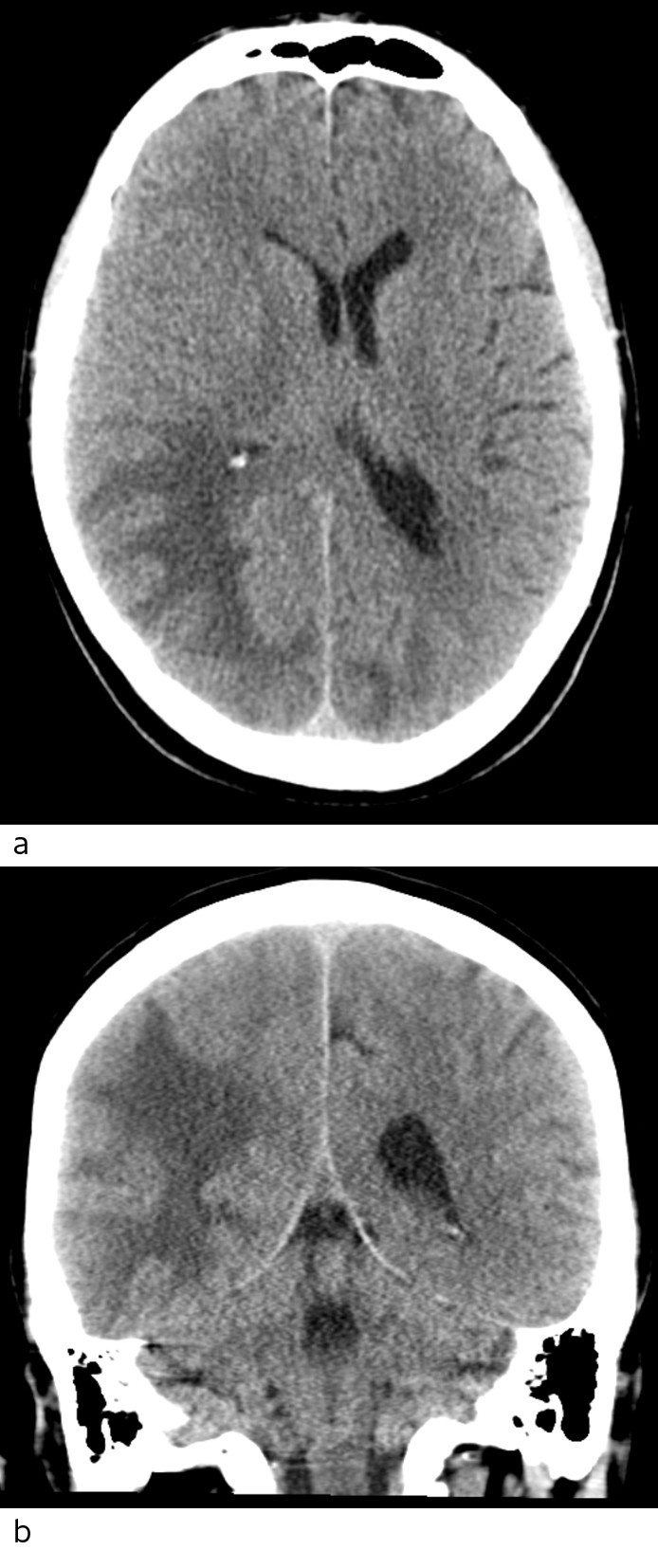 Figure 1 Head CT scan axial section (a) and coronal section (b) show extensive low-density changes that may be consistent…