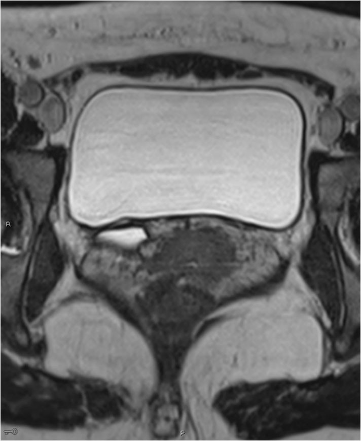 Figure 2 MRI. Transverse 3D section with high resolution T2 weighting shows a right-sided dilated ectopic ureter.