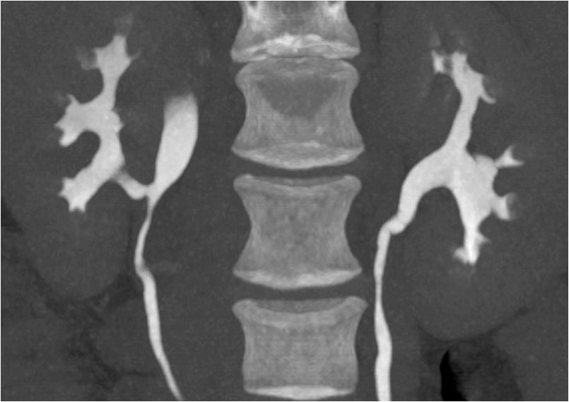 Figure 6 Low-dose CT with contrast in the excretion phase five months post-surgery. The images are taken in the prone&hellip;