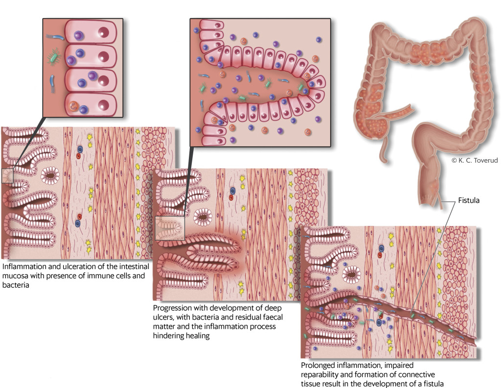 Figure 1 Assumed pathogenesis of fistulising Crohn's disease
