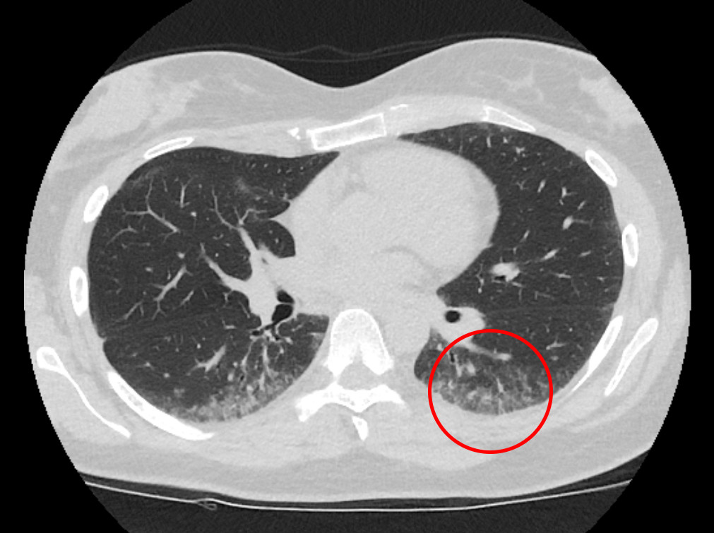 Figure 1 High-resolution thoracic CT shows peripheral subpleural micronodular lung opacities with some ground glass…