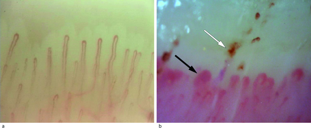 Figure 2 a) Nailfold capillaroscopy in a healthy person with normal capillary density and architecture. B) Capillaroscopy of…